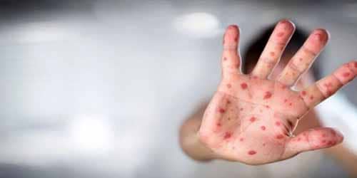 بیماری آبله میمونی چیست؟